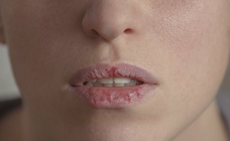 Your Skin - Woman - Dry Lips