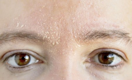 Your Skin - Woman - Atopic dermatitis
