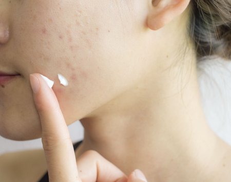 your-skin_sebium-sensitive_How-do-you-treat-acne-prone-skin