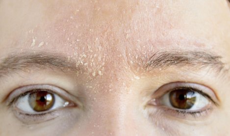 Your Skin - Woman - Atopic dermatitis